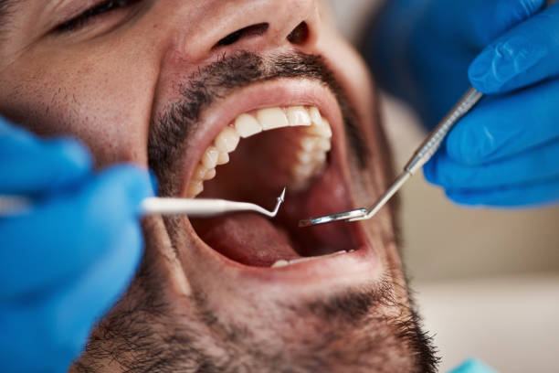 Best Emergency Root Canal Treatment in Mattawan, MI